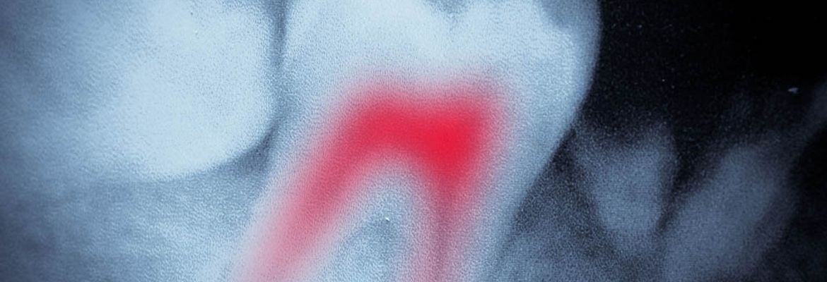 root canal nerve in red