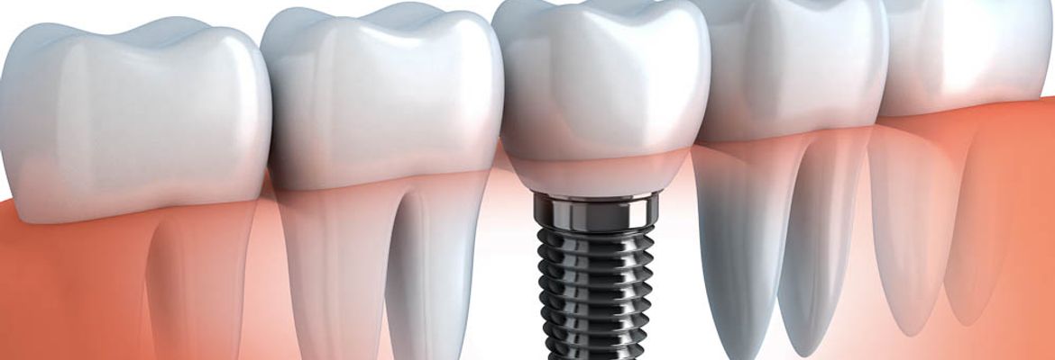 dental implants in costa rica